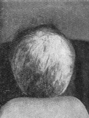 Рис. 28. Веретенообразная перемежающаяся атрофия волос